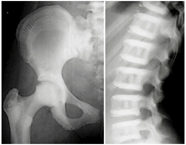 Osteopetrosis